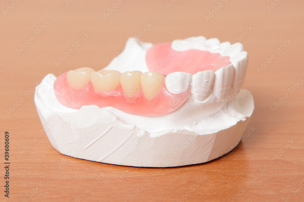 丙烯酸义齿（假牙）