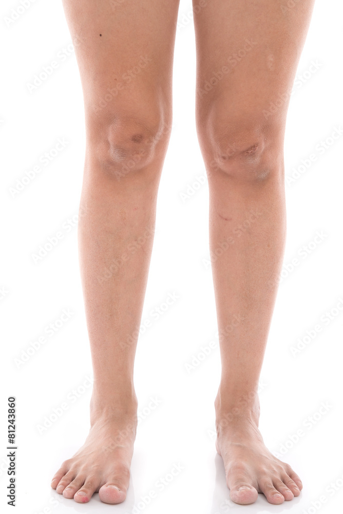 特写女性腿部的疤痕