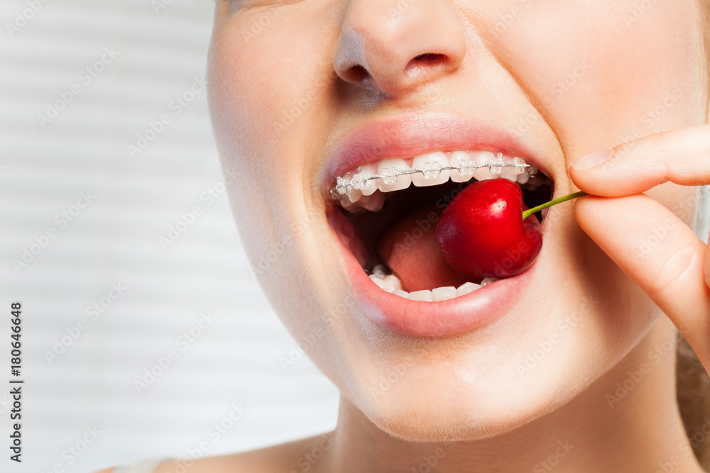 戴着牙托的女人咬掉红樱桃