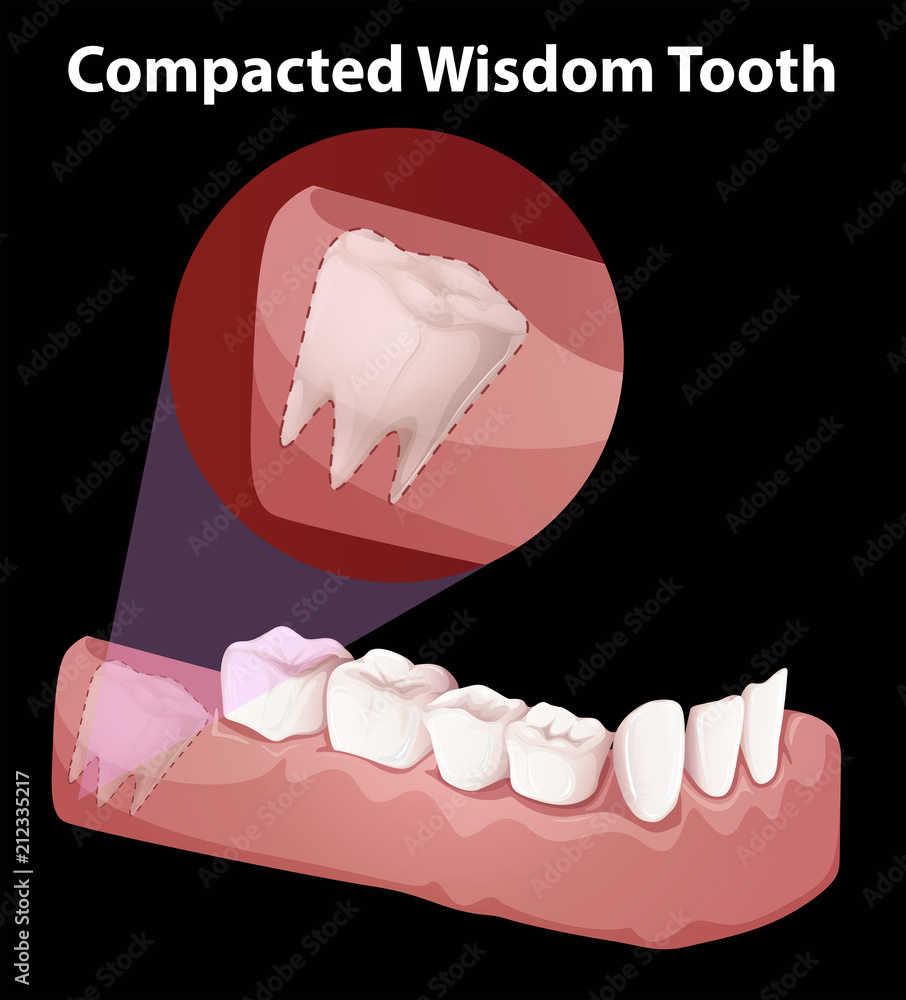 Compacted Wisdom Tooth Diagram