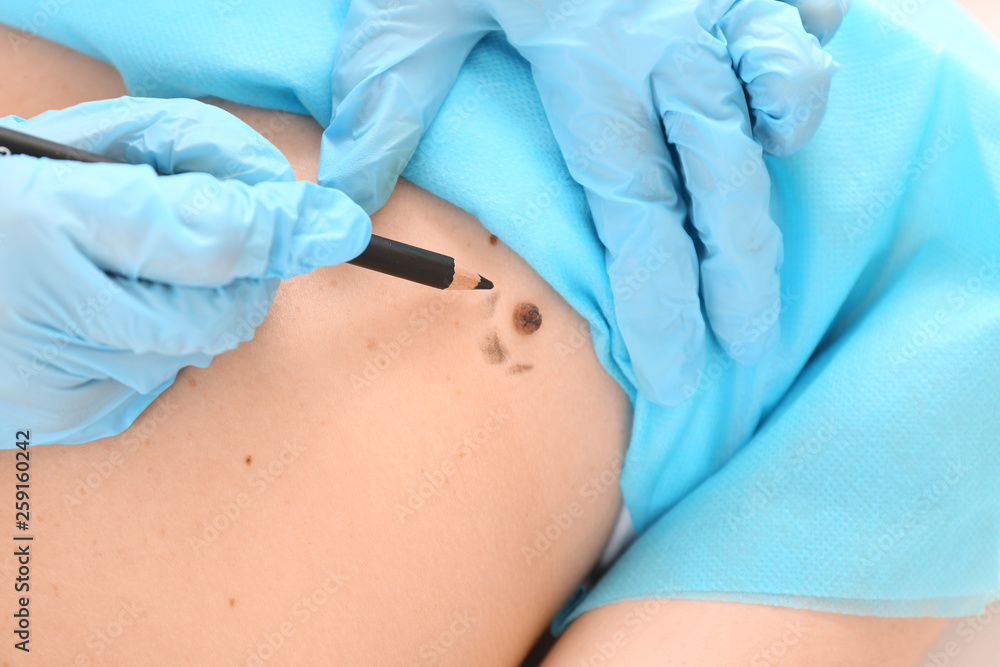 Dermatologist applying marks onto patients skin before moles removal, closeup