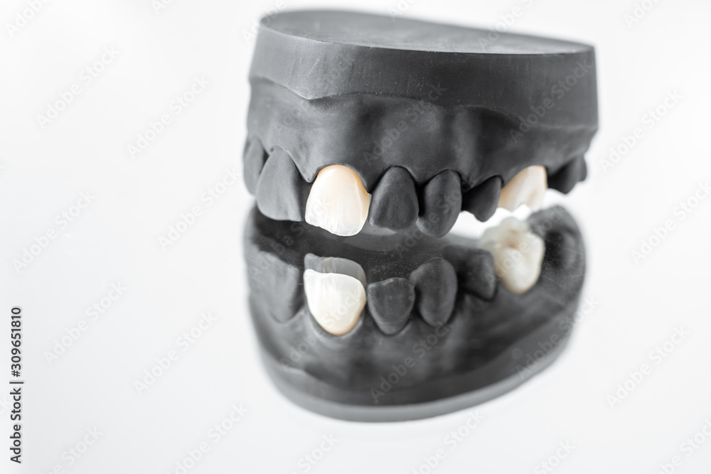Close-up on plaster model of painted in black artificial jaw with implant crown on the mirror backgr