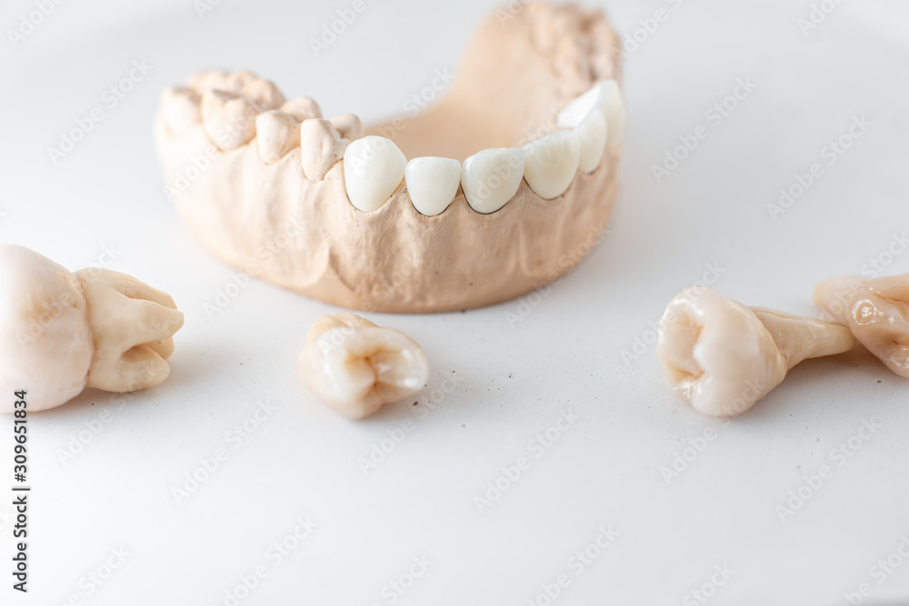白色背景下的人工颌和牙齿石膏模型特写。aes中的艺术概念