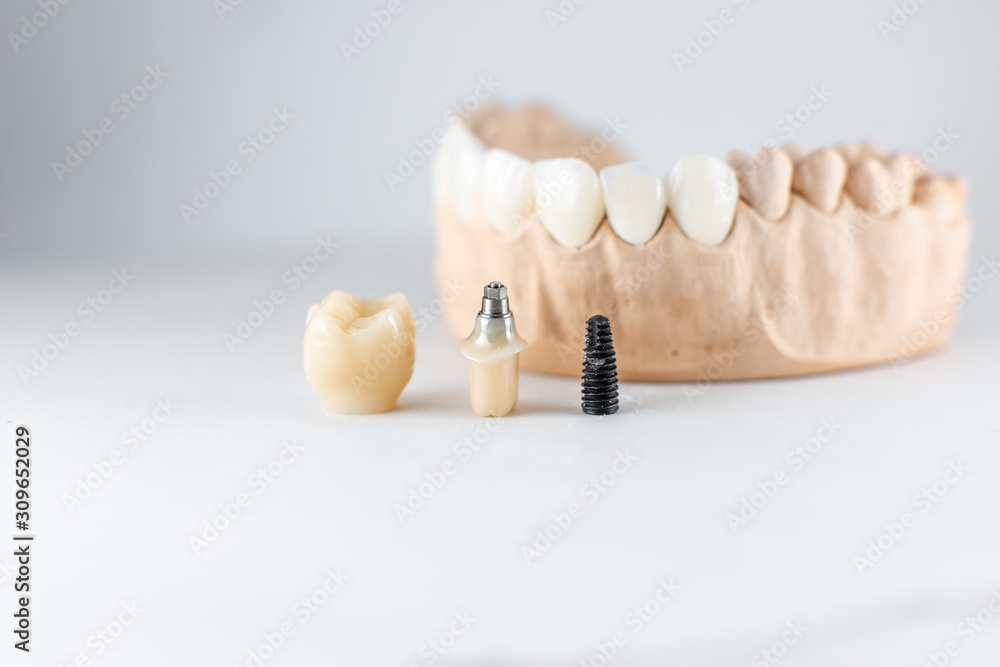 白色背景下的人工颌和牙科植入物石膏模型特写。p的概念