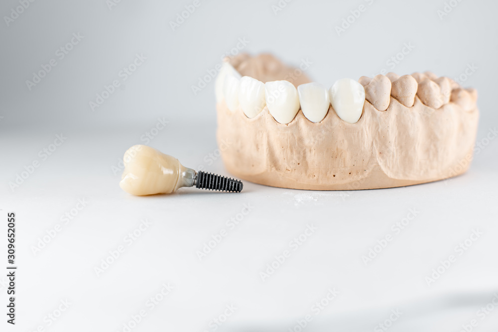 白色背景下的人工颌和牙种植体石膏模型特写。p的概念