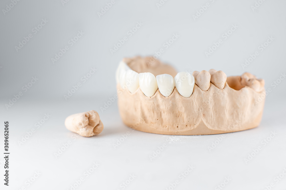 白色背景上有贴面和牙齿的人工颌石膏模型特写。概念