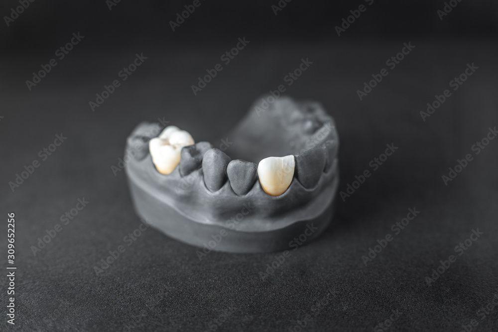 黑色假牙石膏模型的特写，黑色牙背上有种植牙冠