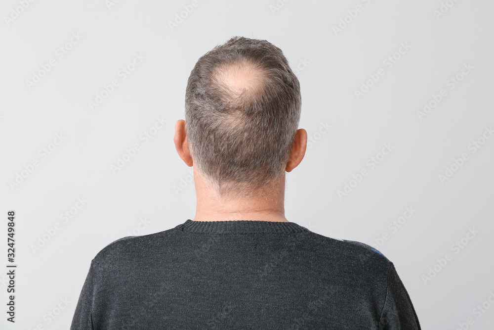 Senior man with hair loss problem on light background