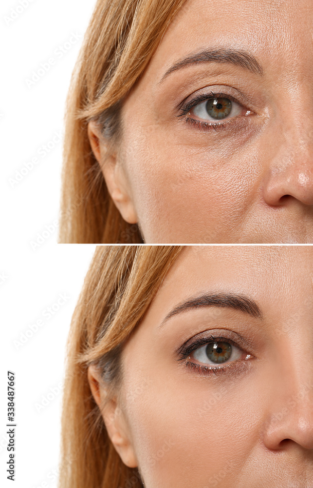 Woman before and after plastic surgery on white background, closeup