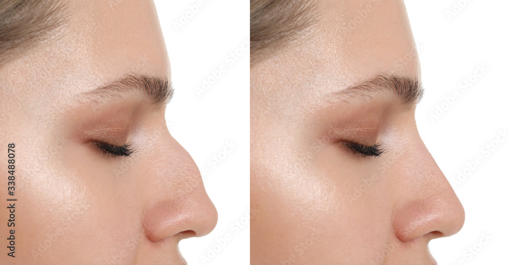 Woman before and after rhinoplasty on white background