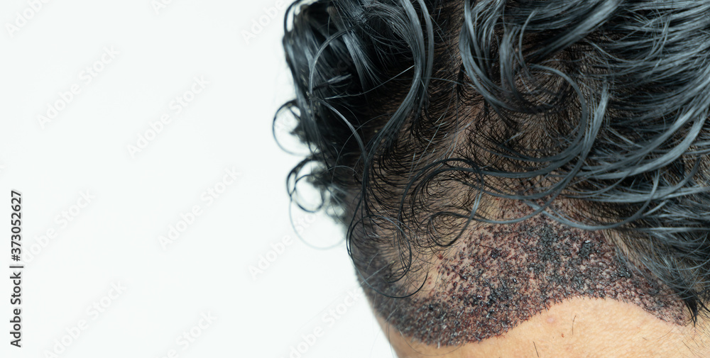 带后退发线的男性头部毛发移植手术，FUE，毛囊单位提取，类型