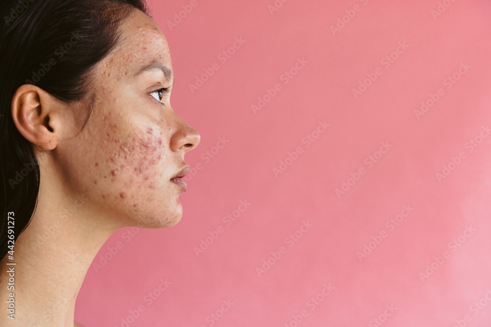 皮肤病可能导致女性自尊低下