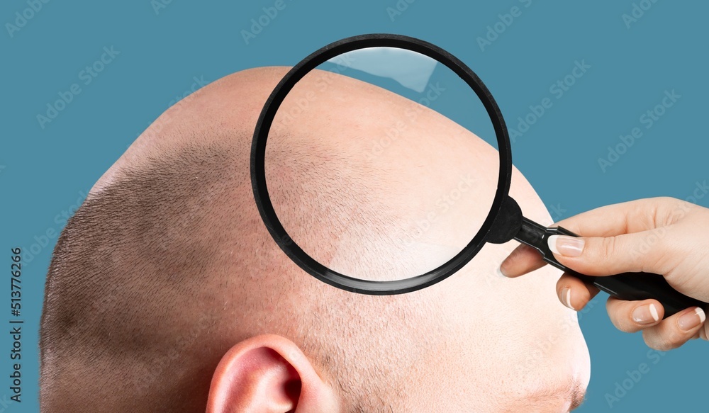 一个头顶脱发的男人。医生用放大镜观察秃头。